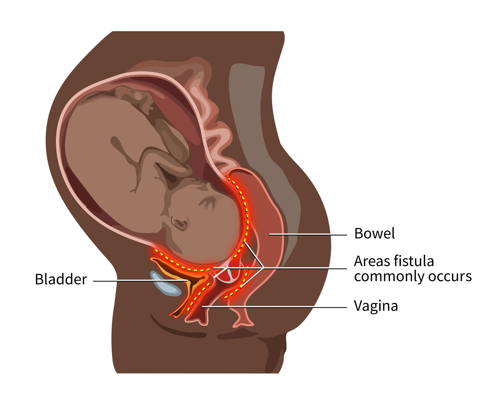 What Are Obstetric Fistula?